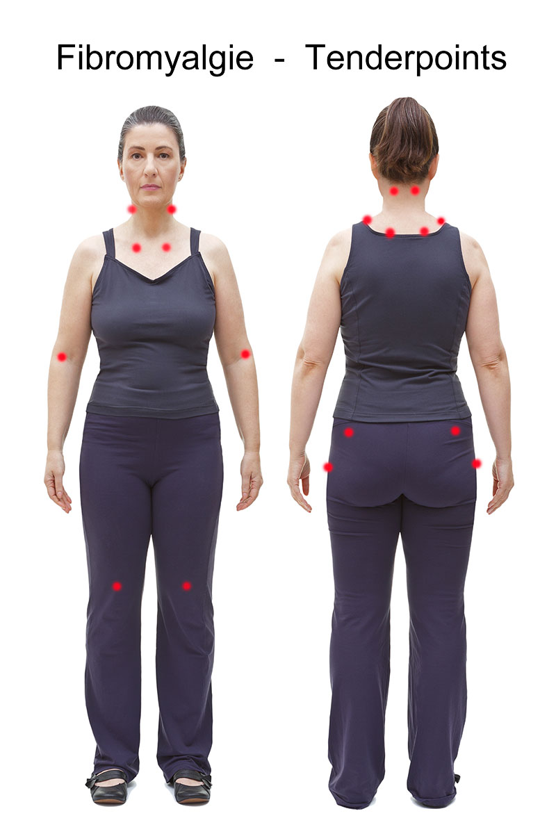 Fibromyalgie Fibromyalgie